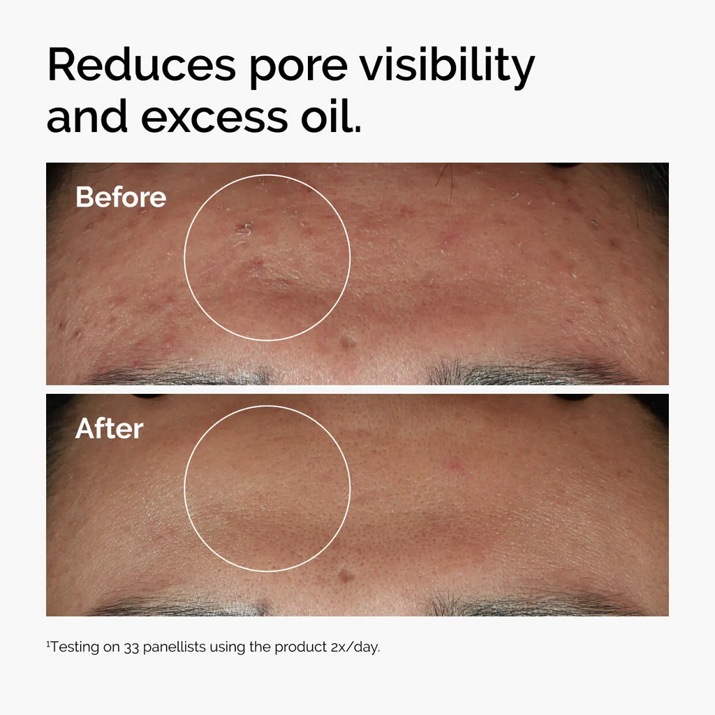 Niacinamide 10% + Zinc 1%, Smoothing Serum for Blemish-Prone Skin