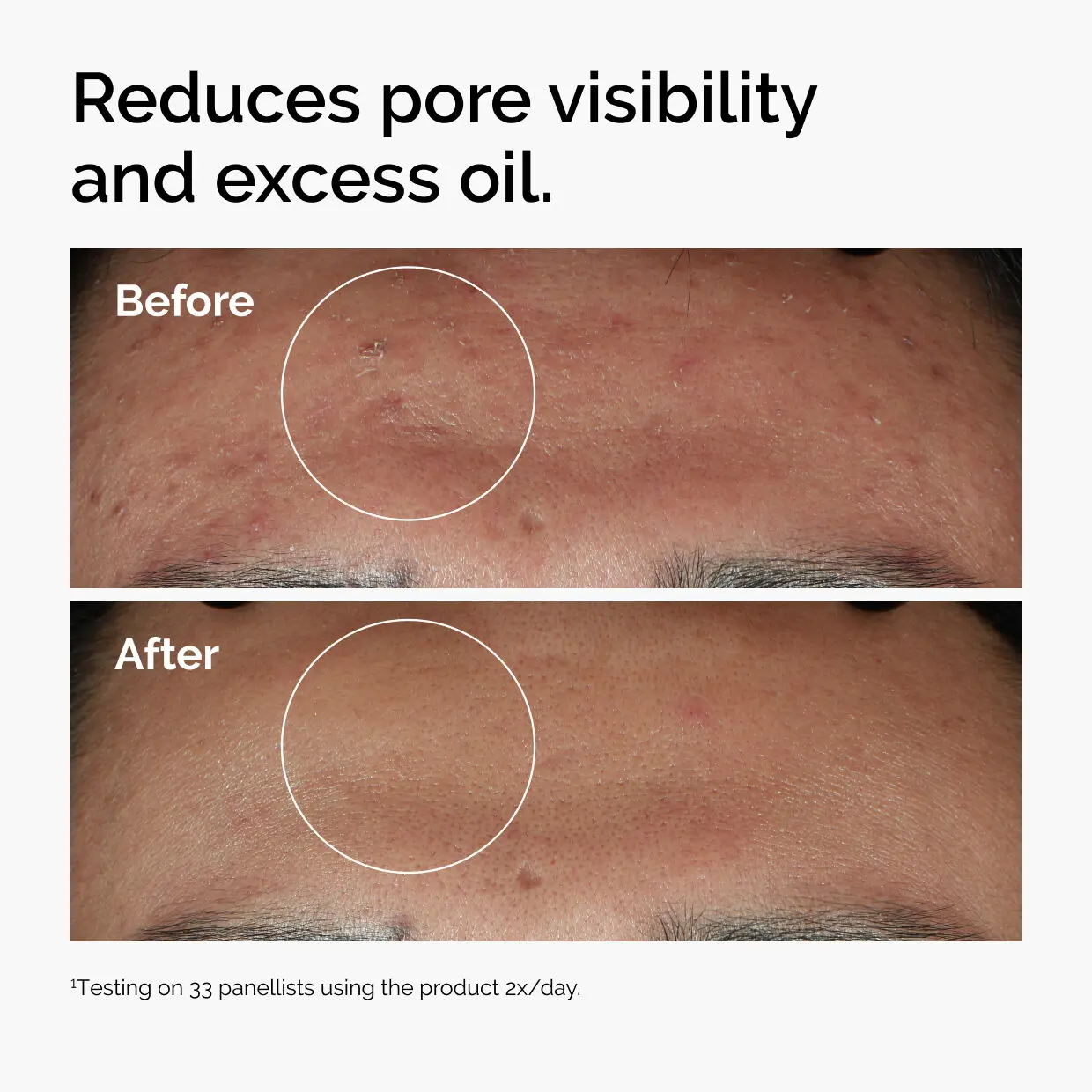 Niacinamide 10% + Zinc 1%, Smoothing Serum for Blemish-Prone Skin