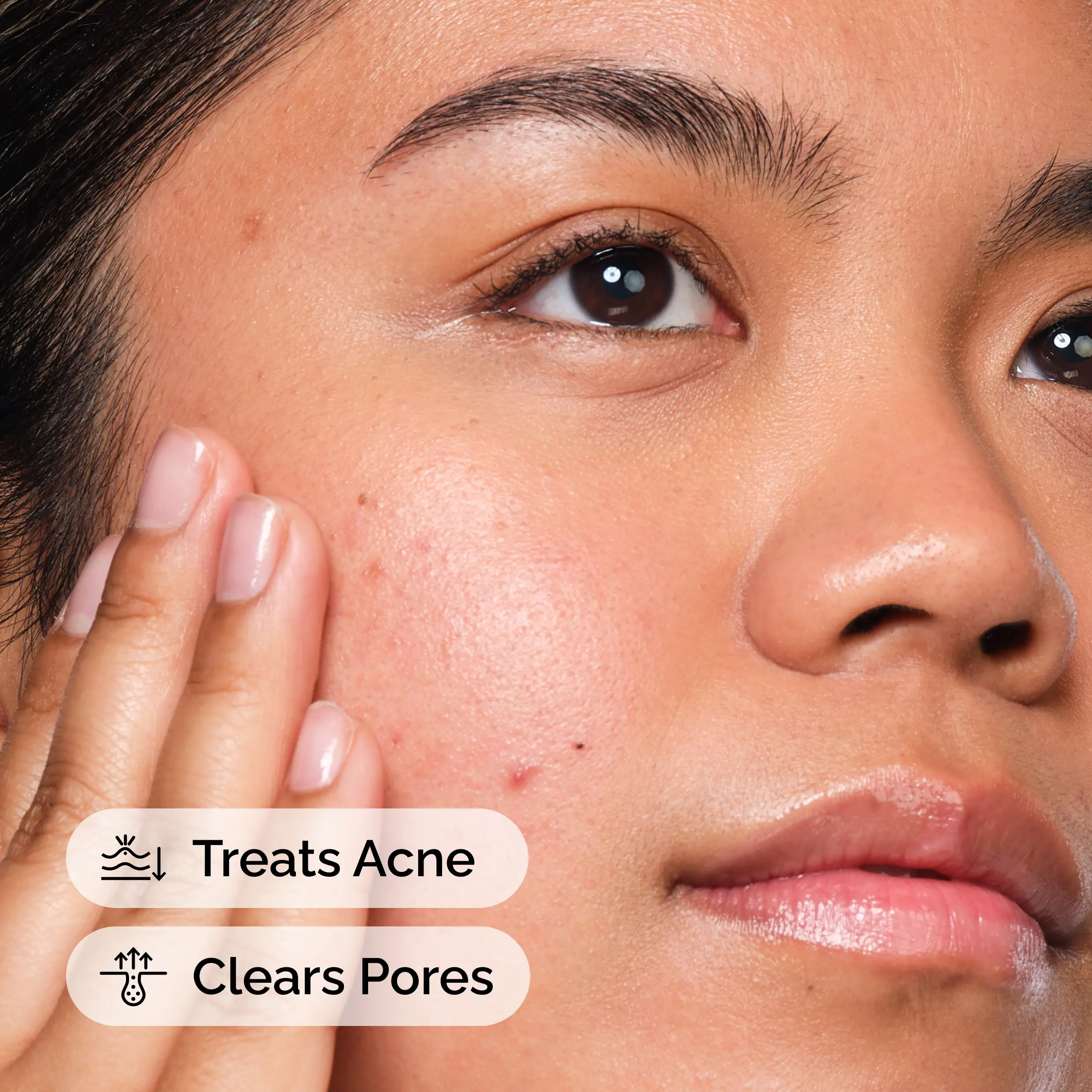 The Acne Set, 3-Step Skin Regimen with Glucoside Foaming Cleanser